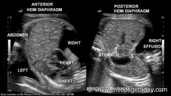 Fetal Surgery Boosts Survival for Babies With Severe Birth Defect