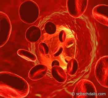 COVID Vaccine Linked to Low Blood Platelet Count – Idiopathic Thrombocytopenic Purpura