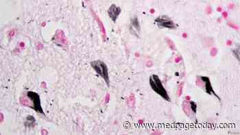 Alzheimer's Tau Vaccine Shows Immune Response, Safety