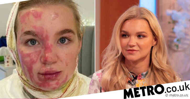 AJ Pritchard’s girlfriend Abbie Quinnen reveals extent of horrific burns six months on: ‘Some days I sit inside and cry all day’