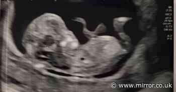 Football-mad dad spots team's crest in scan of his unborn baby