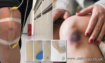 Hong Kong researchers create artificial skin that mimics bruising by turning purple when hit