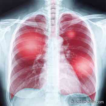 Doctors’ Hopes Dashed: Antibiotics No Help for Mysterious Lung-Scarring Disease