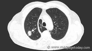 LDCT Screening Linked to Lower Risk of Brain Mets in Lung Cancer