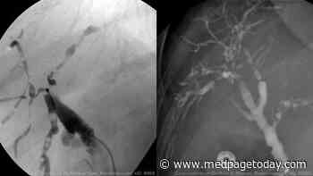 Cases of Rare Liver Complication Seen With Severe COVID-19
