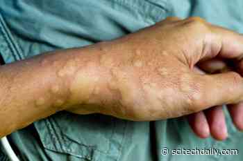 Skin Reactions After COVID-19 Vaccination: Rare, Usually Don’t Recur After Second Dose