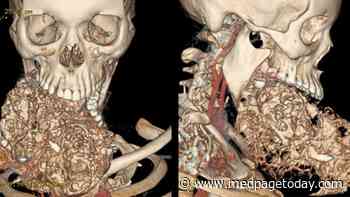 Woman Loses 6-Year Battle With Mouth Tumor