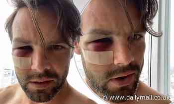 Rugby star Ben Foden showcases excruciating facial injury with black eye and swelling