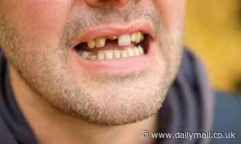 People who start losing their teeth are more likely to develop DEMENTIA