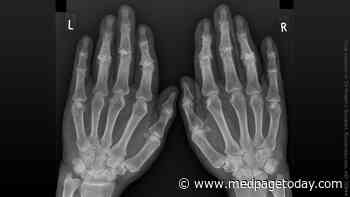 Effective Treatments for Hand Osteoarthritis: The Search Goes On