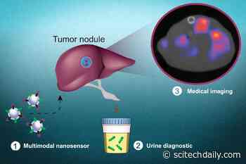 A Noninvasive Test Using Nanoparticles to Detect Cancer Cells and Pinpoint Their Location
