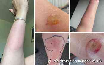What to do if you are bitten by a horsefly