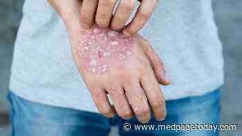 Rates of Serious Infection Differ Among Psoriasis Therapies