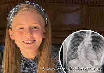 Barley 15-year-old who loves dance has had operation to correct scoliosis