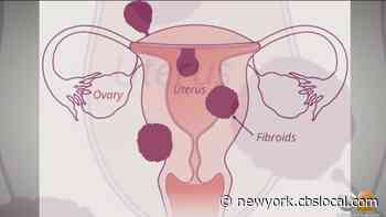 New Medical Options For Uterine Fibroids Include Radio Frequency Ablation, New Drugs - CBS New York