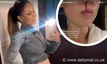 Louise Thompson reveals she suffers regular nosebleeds while carrying her child
