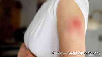 Second Dose of COVID Vaccine Safe Even After Allergic Reaction