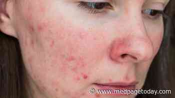 Acne Takes a Toll on Women's Mental Health, Quality of Life