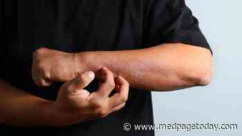 Clinical Challenges: Chronic Itch in Atopic Dermatitis