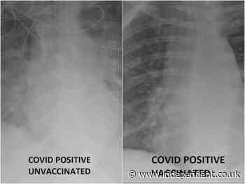 X-rays show difference of Covid’s effect on vaccinated and unvaccinated patients