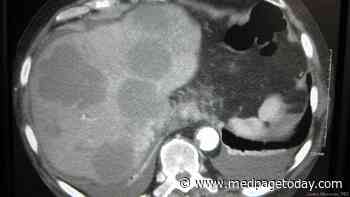 Combination Improves Survival in Hepatitis-Related Liver Cancer