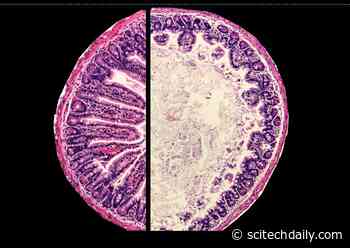 Oral Vaccines Sometimes Fail in Resource-Poor Countries – New Research Helps Explain Why