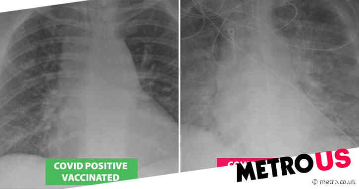 X-rays show how Covid damages lungs of unvaccinated patients