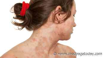 Clinical Challenges: Managing Mental Health in Eczema Patients