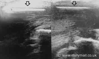 Man has a missing 3/4in nail removed from his scrotum after he shot himself with a nail gun in Italy