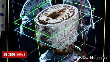 Artificial Intelligence may diagnose dementia in a day