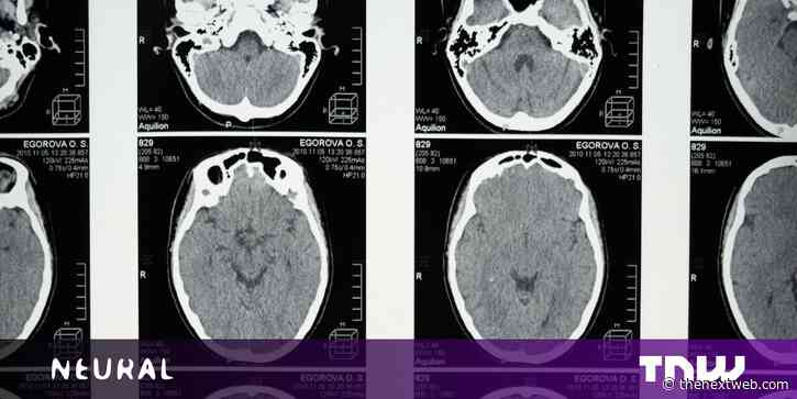 Cambridge scientists say new AI tool could diagnose dementia from a single brain scan