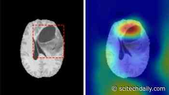 Artificial Intelligence Classifies Brain Tumors With Single MRI Scan