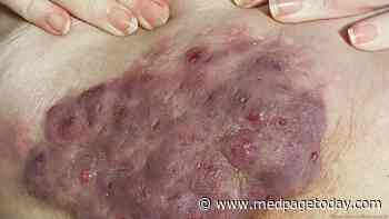 Clinical Challenge: Diagnosing Hidradenitis Suppurativa