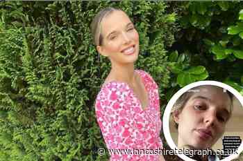 Helen Flanagan opens up about her pregnancy disorder