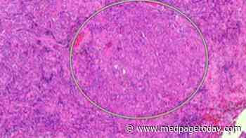 Rare Tumor-to-Tumor Metastasis Takes an Unusual Direction