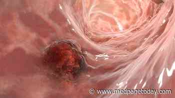 Are Early-Onset Colorectal Cancers More Aggressive?