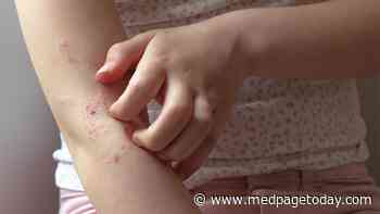 Oral Drug Active in Teens With Atopic Dermatitis