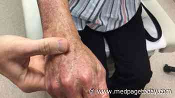 What's Causing Cancer Patient's Joint Pain While on Checkpoint Inhibitor?