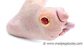 Topical Cream Effective Against Diabetic Foot Ulcers
