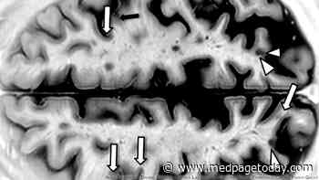 BTK Inhibitor Reduces New Lesions in Relapsing Multiple Sclerosis