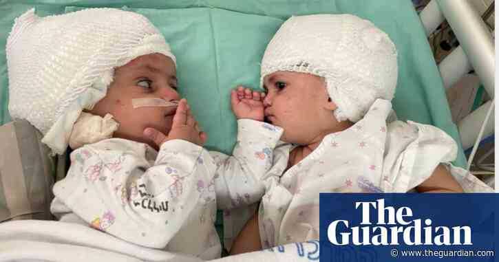 Israel: one-year-old conjoined twin girls see each other for the first time after surgery – video