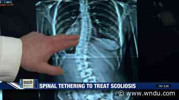 Medical Moment: Spinal tethering to treat scoliosis - WNDU-TV
