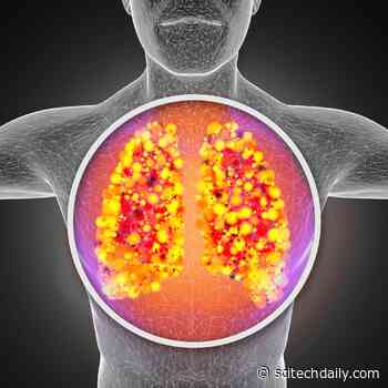 Why People With Diabetes Develop Severe COVID-19 – Mechanism Behind Coronavirus Cytokine Storms Revealed - SciTechDaily