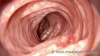 AI's Help in Colonoscopy Led to Fewer Missed Adenomas