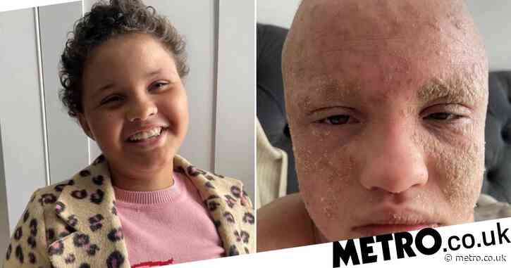 Schoolgirl loses sight in one eye after using anti-inflammatory creams for eczema
