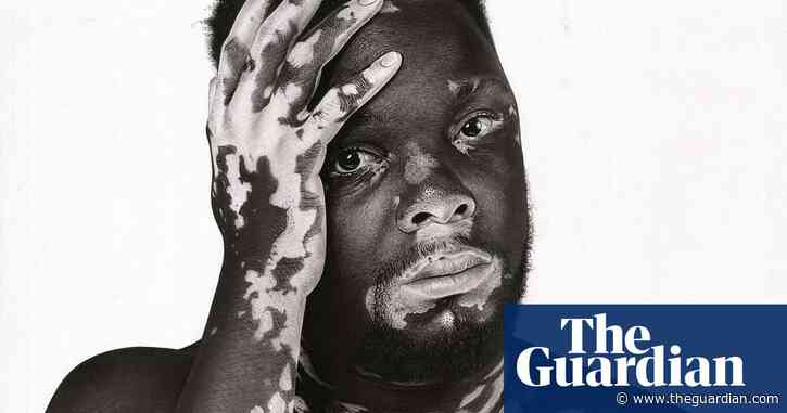 Embracing vitiligo: Ugandan artist dispels skin stigma with portraits