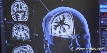 Deep brain stimulation may ease opioid addiction when other treatments fail