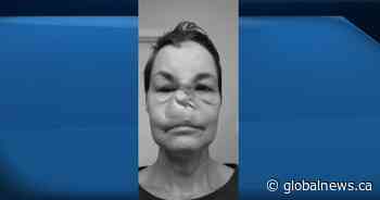 COVID-19: Saskatchewan woman who was scared after Alberta surgery cancelled says it’s back on