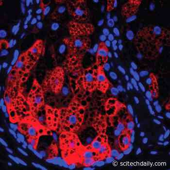 Gene for Sex Hormone Synthesis May Play Key Role in Eczema