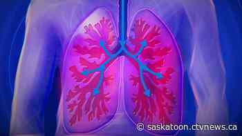 Saskatoon researchers make Cystic Fibrosis breakthrough | CTV News - CTV News Saskatoon